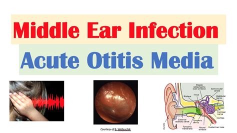 middle ear infection acute otitis media causes symptoms diagnosis treatment youtube