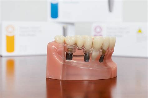 How Long Do Dental Implants Last Fairfield Ct