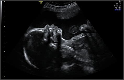 【ベストコレクション】 24 Weeks Pregnant Ultrasound Gender 220010 24 Weeks
