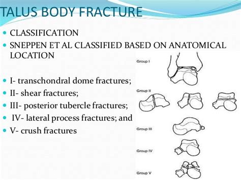 Talus Fracture Classification