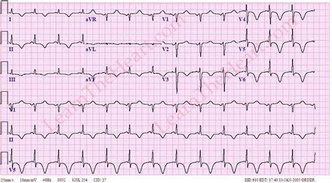 Cerebral Ich Ecg Example 1