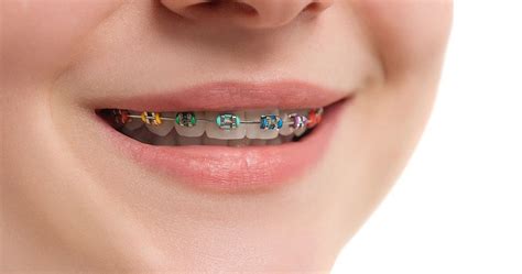 A Guide To Fun Colored Braces Nevada Dentistry And Braces