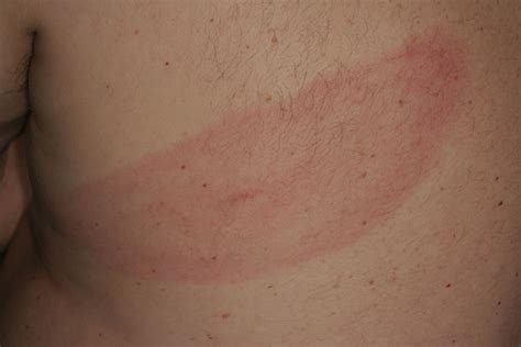 Erythema Chronicum Migrans Doccheck