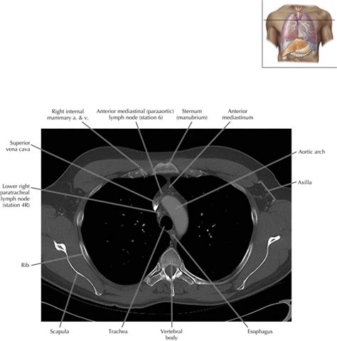 Thoracic Lymph Nodes Radiology Key