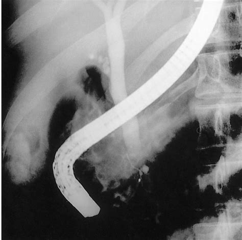 Endoscopic Cholangiopancreatography Ercp Shows A Short Duct In The