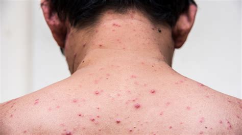 Chickenpox In Adults Superdrug Health Clinic