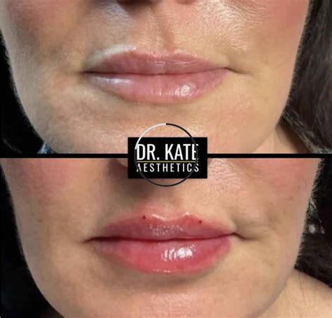 before and afters lip fillers aesthetics and skin care clinic in north london dr kate aesthetics