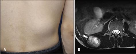 A A 75 Mm×70 Mm Movable Subcutaneous Nodule On The Right Side Of