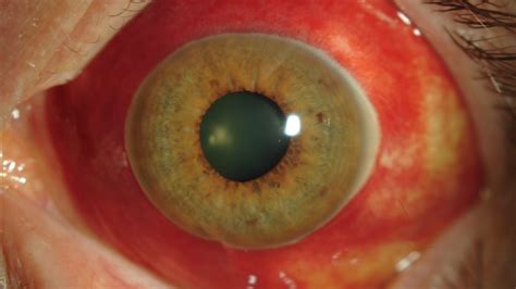 Hemorragia Subconjuntival Sangre En El Ojo Centro De Oftalmología