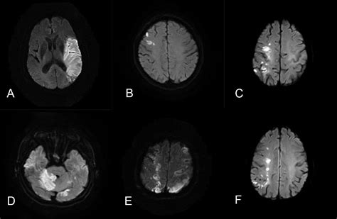 Trousseau Syndrome Related Cerebral Infarction Clinical Manifestations