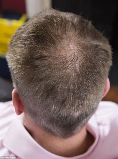 Andrew Pierce Was Horrified To Discover He Had Thinning Hair But 55