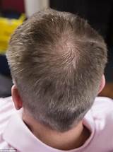 Alopecia Mayo Clinic Pictures