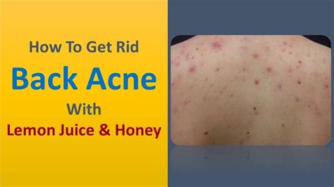 How To Get Rid Back Acne With Lemon Juice And Honey Youtube