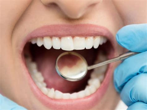 Cracked Tooth Symptoms Diagnosis And Treatment
