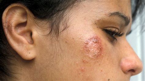 Herpes Rash On Face Pictures Goimages Inc