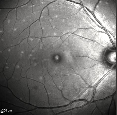 Pattern Dystrophy Simulating Fundus Flavimaculatus Retina Image Bank