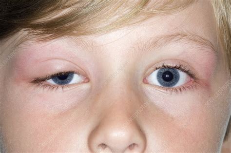 Mosquito Bite Allergy Eye