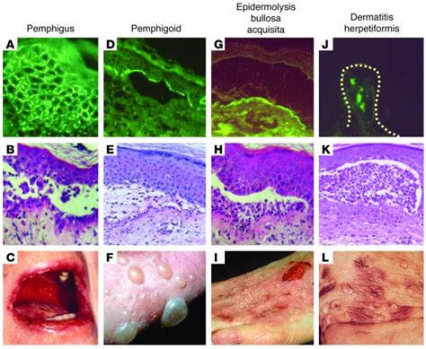 Jci T Cell Control In Autoimmune Bullous Skin Disorders