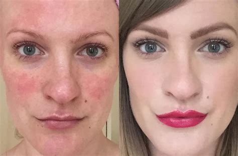 Blogger With Rosacea Reveals How Cutting Out Gluten Dramatically