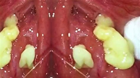 Tonsil stones are particles of rotting/rotted food trapped in the folds of the tonsil and acted on by the bacteria that live in your mouth and throat. Tonsil Stones & Blackhead Removal on the Weird Side of ...