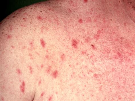 Hiv Rash Pictures What Does Hiv Rash Look Like How Is Vrogue Co