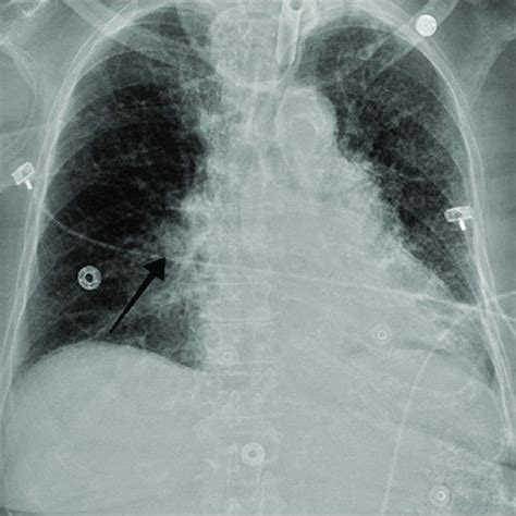 Chest Radiograph On Admission Showing Bilateral Coarsened Appearance