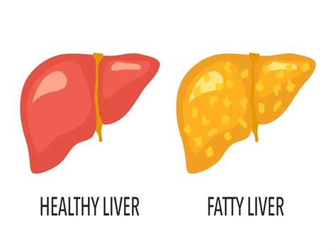 Fatty Liver Disease How To Identify If You Have Fatty Liver The