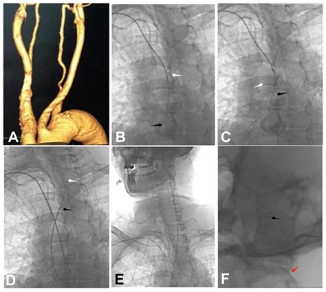 Frontiers Transradial Access With Intra Aortic Catheter Looping For
