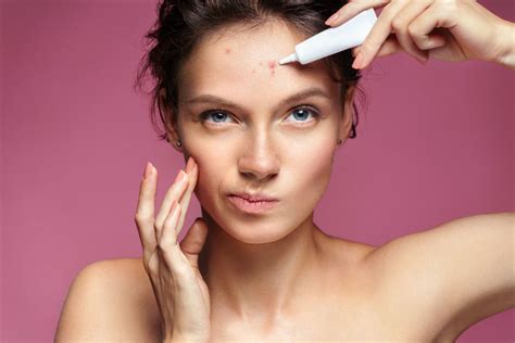 Treatments And Home Remedies For Acne Style Vanity