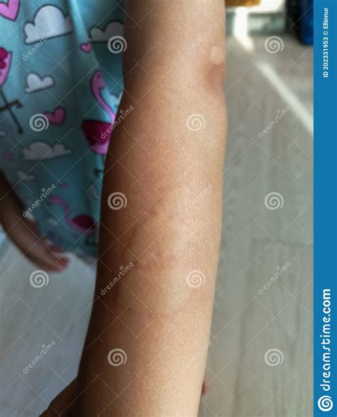 Little Girl Has Allergies With Mosquitoes Bite And Itching Her Skin