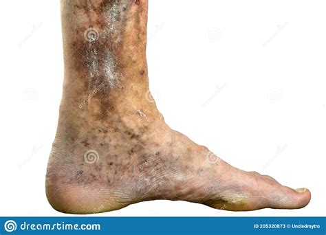 Sore Spotty Leg Of Person Suffering From Blockage Of Veins Ulcers