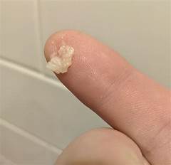 Large Cysts Popped