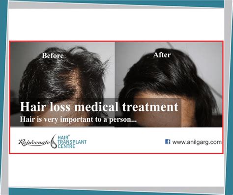 Medial Treatment For Hair Loss And Hair Fall Rejuvenate
