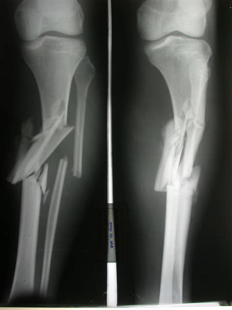 Understanding The Different Types Of Bone Fractures C