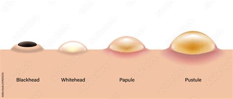 Type Of Acne Diagram Skin Acne On Side View Blackhead Whitehead