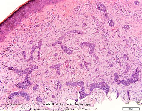 Pathology Outlines Basal Cell Carcinoma Bcc