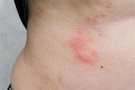Home Remedies And Treatment Options To Get Rid Of Hives Fast