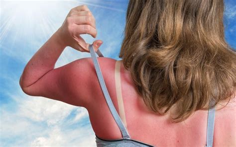 Sunburn On Face Causes Symptoms And Treatments Skinkraft