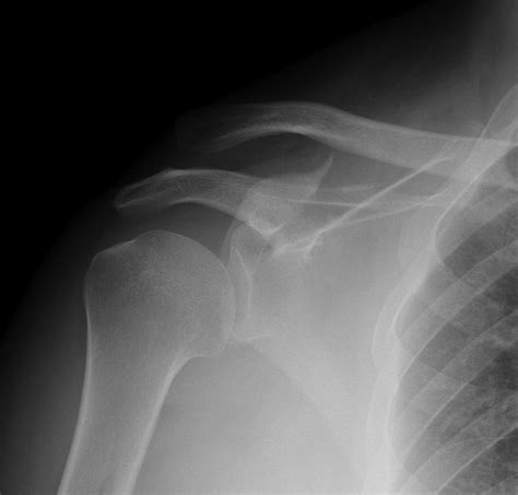 Glenoid And Scapula Fractures The Bone School