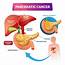 Pancreatic Cancer Awareness Risk Diagnosis & Prevention