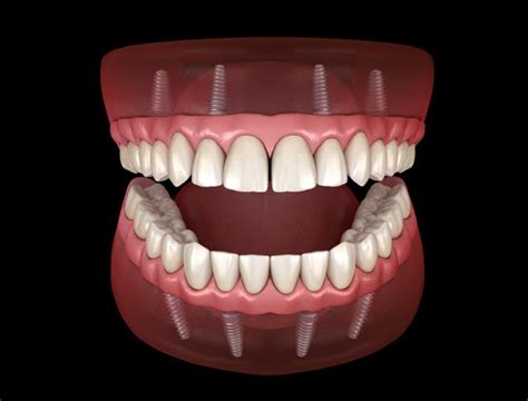 What Are Implant Supported Dentures Smiles On Michigan Chicago Illinois
