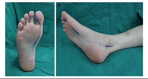 Figure 2 From Operative Treatment For Ganglion Cyst Of Flexor Hallucis