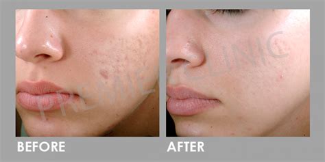 Microdermabrasion For Skin Pigmentation Treatment Premier Clinic