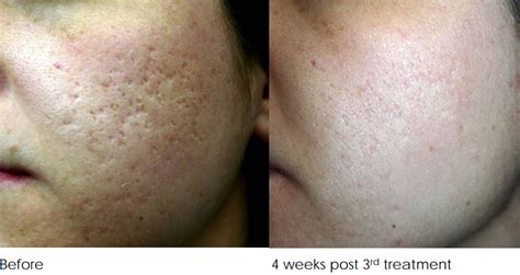 Acne Scar Removal Treatment Melbourne Before And After 3