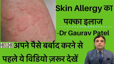 स्किन ऐलर्जी का इलाज।skin Allergy Treatment At Home By Dermatologist