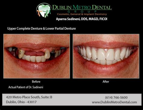 This base is connected to a metal frame that keeps the denture in place. Upper Complete Denture & Lower Partial Denture. | Partial ...
