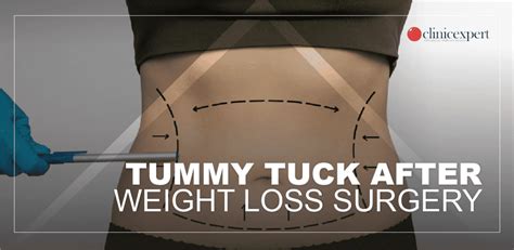 Tummy Tuck After Weight Loss Surgery Clinicexpert