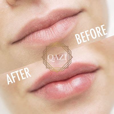 Lip Fillers In Newport Beach California Qazi Cosmetic Clinic
