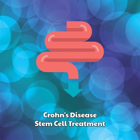 Crohns Disease Stem Cell Treatment Dreambody Clinic