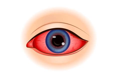 Poor Eyesight Illustrations Royalty Free Vector Graphics And Clip Art